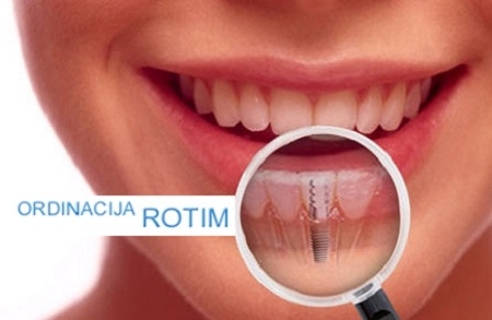 Ugradnja zubnog implantata i metal keramičke krunice u Stom. ordinaciji ROTIM